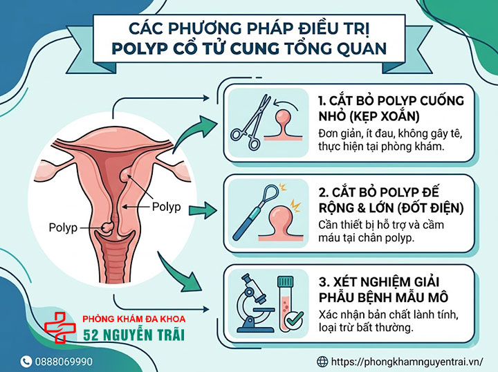 Polyp Cổ Tử Cung Là Gì? Nguyên Nhân, Triệu Chứng Đầy Đủ 6 Các phương pháp điều trị polyp cổ tử cung tổng quan