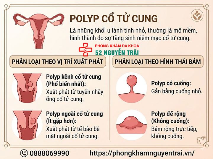 Polyp Cổ Tử Cung Là Gì? Nguyên Nhân, Triệu Chứng Đầy Đủ 1 Định nghĩa, phân loại polyp cổ tử cung