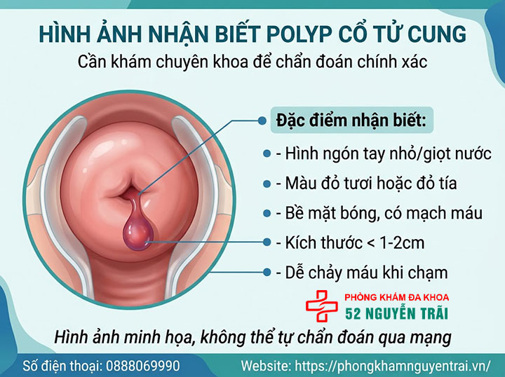 Polyp Cổ Tử Cung Là Gì? Nguyên Nhân, Triệu Chứng Đầy Đủ 2 Hình ảnh nhận biết polyp cổ tử cung