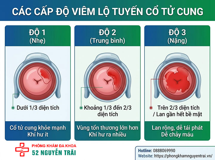 Viêm Lộ Tuyến Cổ Tử Cung Là Gì? Dấu Hiệu, Cấp Độ 3 Các cấp độ viêm lộ tuyến cổ tử cung: 1, 2, 3