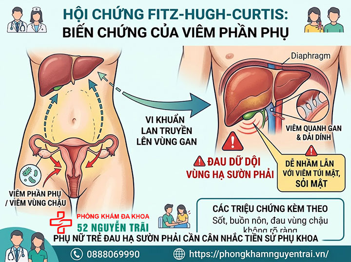 Viêm Phần Phụ Là Gì? Triệu Chứng, Nguyên Nhân 5 Hội chứng viêm phần phụ