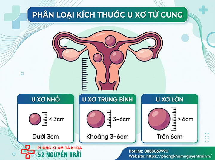 U xơ tử cung là gì? Triệu chứng, nguyên nhân và phân loại đầy đủ 4 Kích thước u xơ tử cung bao nhiêu là nhỏ, bao nhiêu là to?