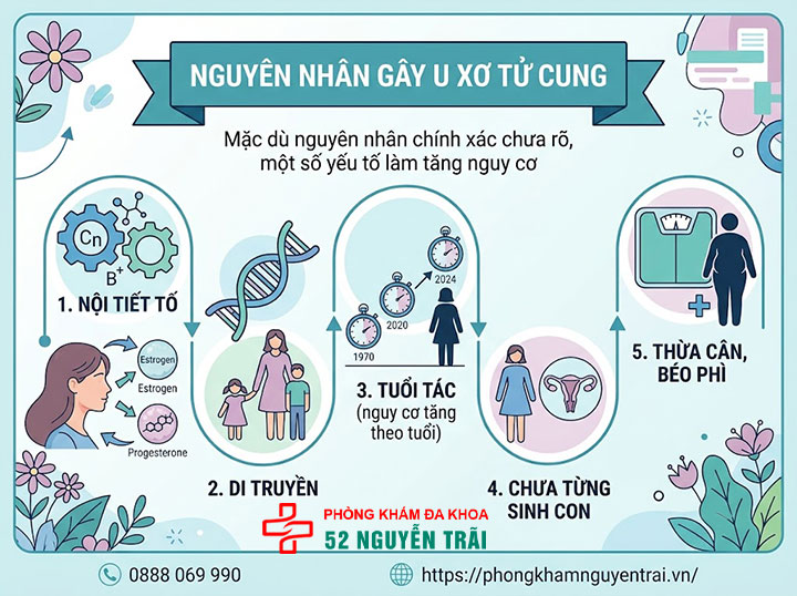 U xơ tử cung là gì? Triệu chứng, nguyên nhân và phân loại đầy đủ 6 Nguyên nhân gây u xơ tử cung
