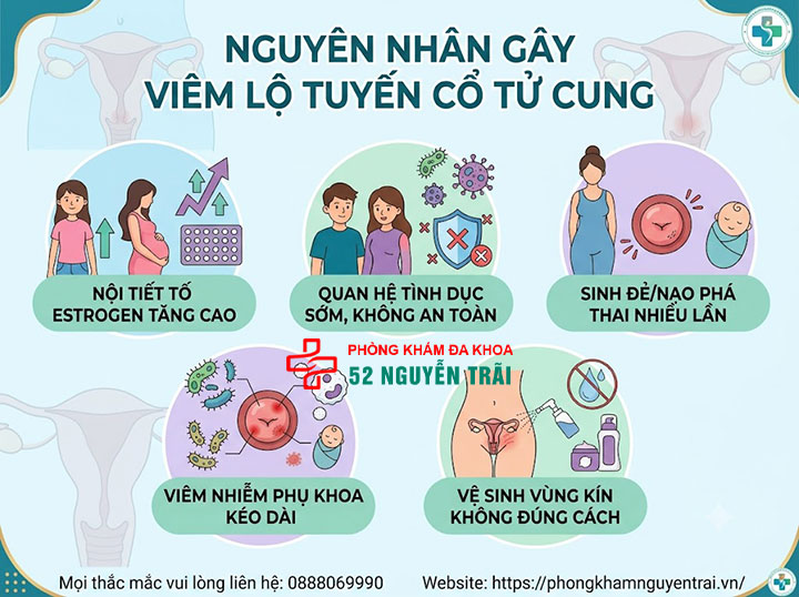 Viêm Lộ Tuyến Cổ Tử Cung Là Gì? Dấu Hiệu, Cấp Độ 6 Nguyên nhân gây viêm lộ tuyến cổ tử cung