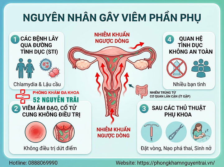 Viêm Phần Phụ Là Gì? Triệu Chứng, Nguyên Nhân 4 Nguyên nhân gây viêm phần phụ