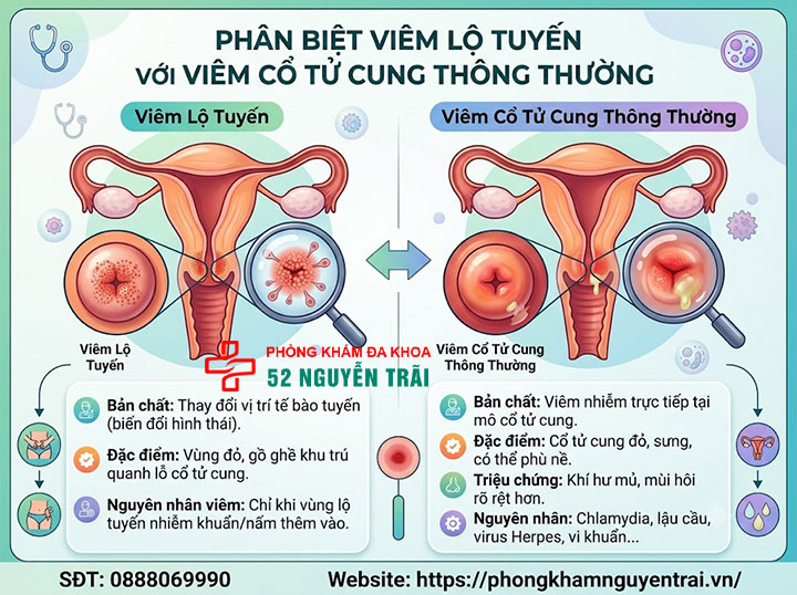 Viêm Lộ Tuyến Cổ Tử Cung Là Gì? Dấu Hiệu, Cấp Độ 7 Phân biệt viêm lộ tuyến với viêm cổ tử cung thông thường