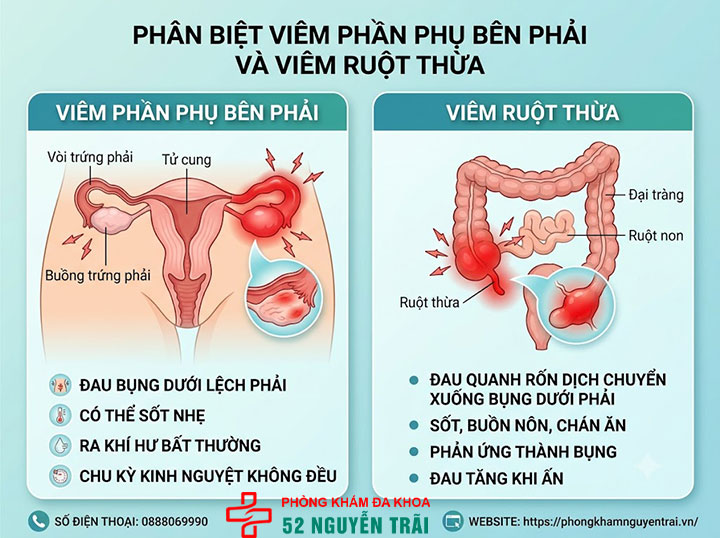 Viêm Phần Phụ Là Gì? Triệu Chứng, Nguyên Nhân 6 Phân biệt viêm phần phụ bên phải với viêm ruột thừa