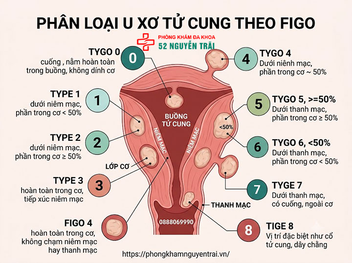 U xơ tử cung là gì? Triệu chứng, nguyên nhân và phân loại đầy đủ 3 Phân loại theo chuẩn FIGO – hệ thống 9 nhóm (Type 0–8)
