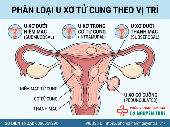 U xơ tử cung là gì? Triệu chứng, nguyên nhân và phân loại đầy đủ 2 Phân loại u xơ tử cung theo vị trí