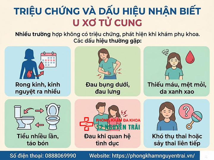 U xơ tử cung là gì? Triệu chứng, nguyên nhân và phân loại đầy đủ 5 Triệu chứng và dấu hiệu nhận biết u xơ tử cung