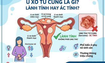 U xơ tử cung là gì? Triệu chứng, nguyên nhân và phân loại đầy đủ