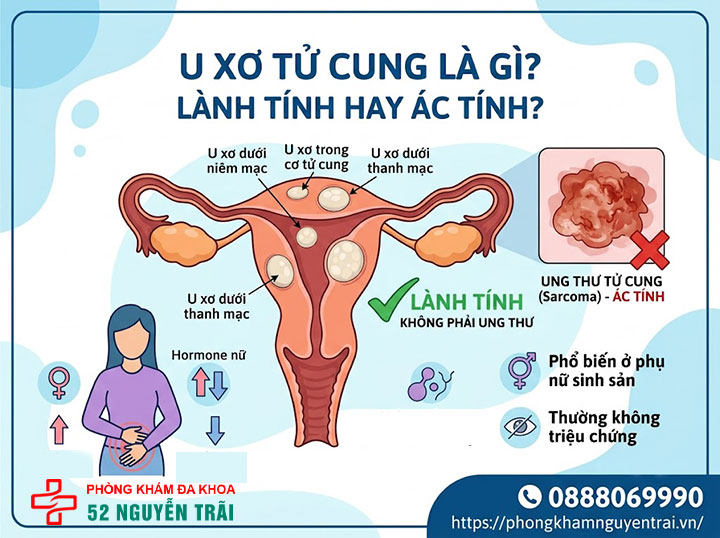 U xơ tử cung là gì? Triệu chứng, nguyên nhân và phân loại đầy đủ 1 U xơ tử cung là gì? Lành tính hay ác tính?