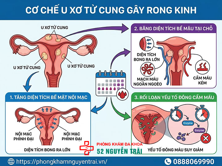 U xơ tử cung là gì? Triệu chứng, nguyên nhân và phân loại đầy đủ 7 Vì sao u xơ tử cung gây rong kinh? Cơ chế sinh lý
