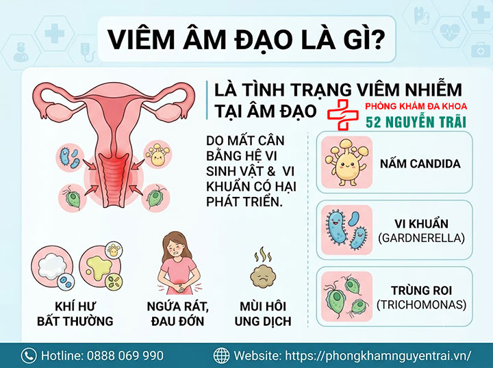 Viêm Âm Đạo Là Gì? Triệu Chứng, Nguyên Nhân Đầy Đủ 1 Viêm Âm Đạo Là Gì?