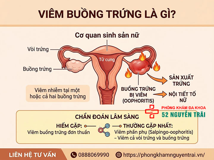 Viêm Buồng Trứng: Triệu Chứng, Nguyên Nhân Đầy Đủ 1 Viêm buồng trứng là gì