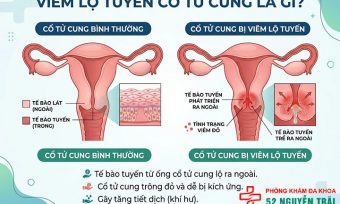 Viêm Lộ Tuyến Cổ Tử Cung Là Gì? Dấu Hiệu, Cấp Độ