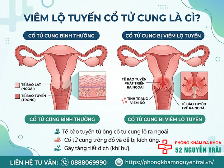 Viêm Lộ Tuyến Cổ Tử Cung Là Gì? Dấu Hiệu, Cấp Độ 1 Viêm lộ tuyến cổ tử cung là gì?
