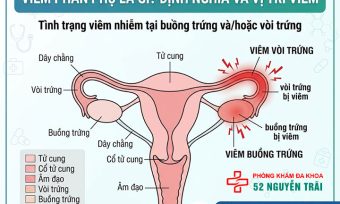 Viêm Phần Phụ Là Gì? Triệu Chứng, Nguyên Nhân