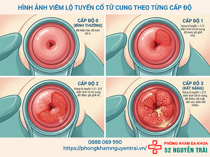 Viêm Lộ Tuyến Cổ Tử Cung Là Gì? Dấu Hiệu, Cấp Độ 8 Hình ảnh viêm lộ tuyến cổ tử cung theo từng cấp độ
