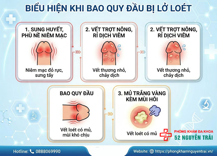 Loét Bao Quy Đầu: Nguyên Nhân Và Cách Điều Trị 1 Biểu Hiện Khi Bao Quy Đầu Bị Lở Loét