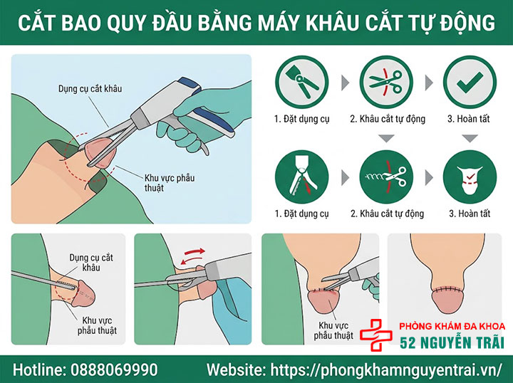 Phẫu thuật dài bao quy đầu: Các phương pháp và quy trình an toàn 4 Cắt bao quy đầu bằng máy khâu cắt tự động