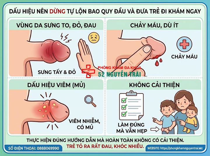 5 Sai Lầm Cha Mẹ Hay Mắc Khi Nong Bao Quy Đầu Cho Bé 3 Dấu hiệu cho thấy nên dừng việc tự thực hiện và đưa trẻ đi khám ngay