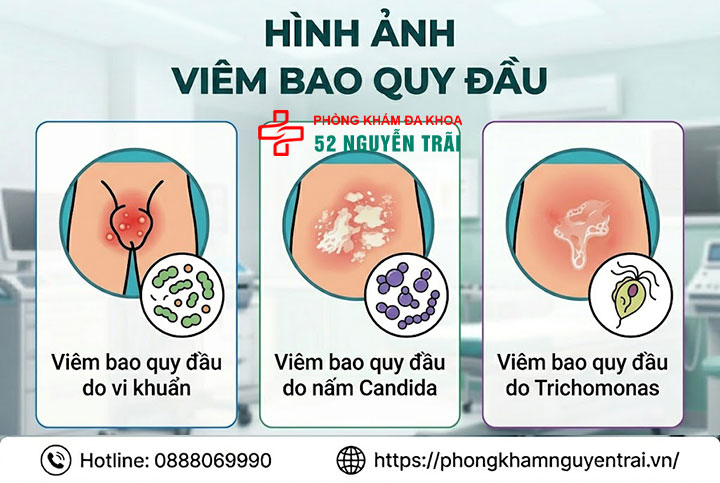 Viêm bao quy đầu: Nguyên nhân, dấu hiệu và cách điều trị 4 Hình ảnh viêm bao quy đầu