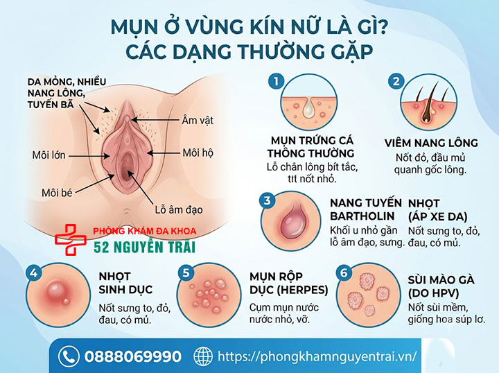 Mụn Ở Vùng Kín Nữ Có Nguy Hiểm Không? Bác Sĩ Giải Đáp 1 Mụn ở vùng kín nữ là gì?