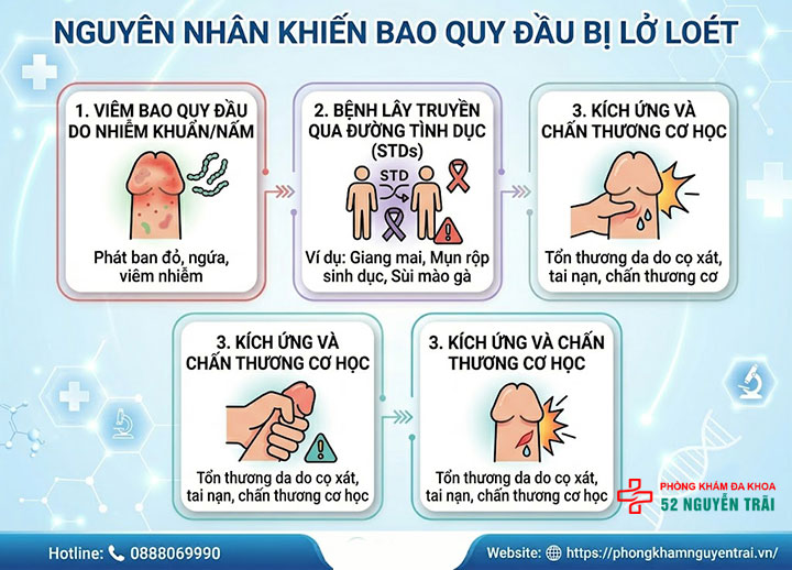 Loét Bao Quy Đầu: Nguyên Nhân Và Cách Điều Trị 2 Nguyên Nhân Khiến Bao Quy Đầu Bị Lở Loét