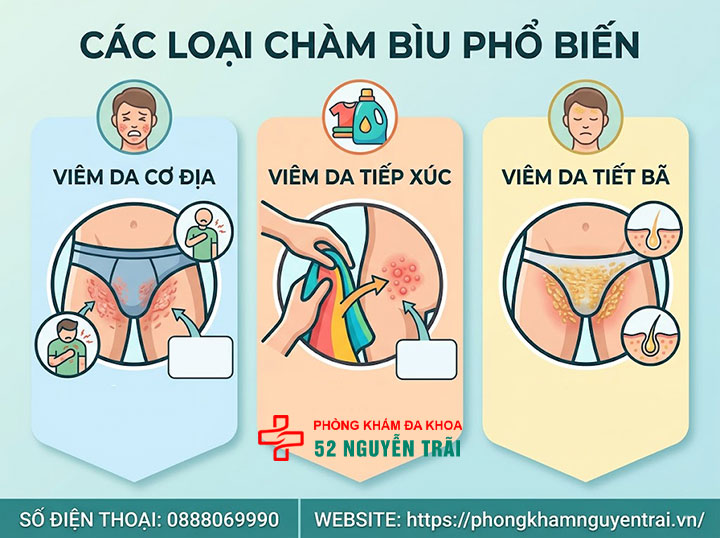 Bệnh Chàm Bìu: Nguyên Nhân, Triệu Chứng Và Điều Trị 2 Các loại chàm bìu phổ biến
