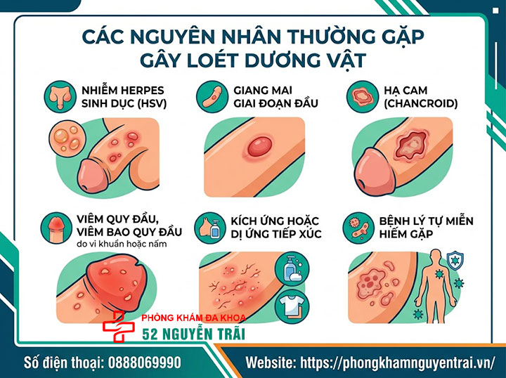 Loét Dương Vật: Nguyên Nhân Và Cách Xử Trí Đúng 2 Các nguyên nhân thường gặp gây loét dương vật