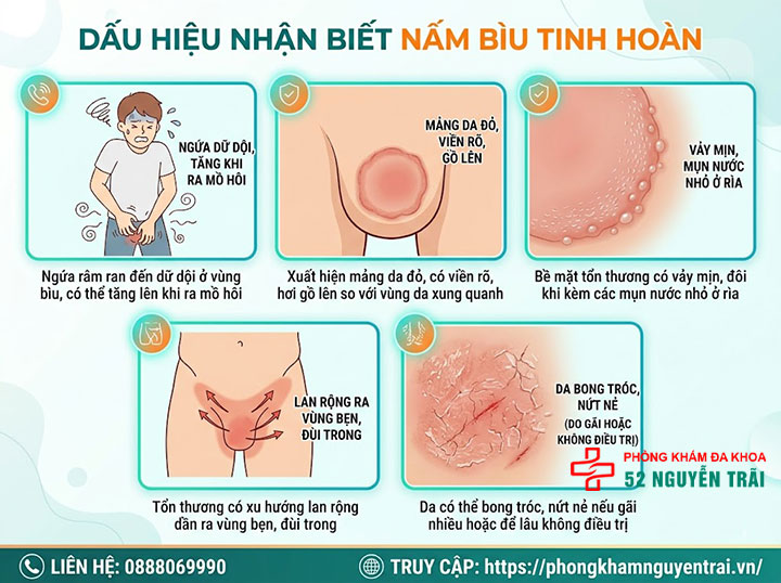 Nấm Bìu Tinh Hoàn: Nguyên Nhân Và Cách Điều Trị 3 Dấu hiệu nhận biết nấm bìu tinh hoàn