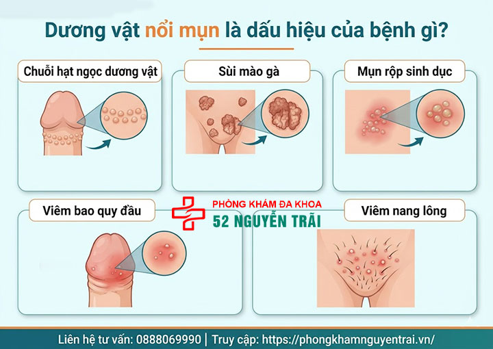 Dương vật nổi mụn: Nguyên nhân, dấu hiệu và cách chữa dứt điểm 2 Dương vật nổi mụn là dấu hiệu của bệnh gì?