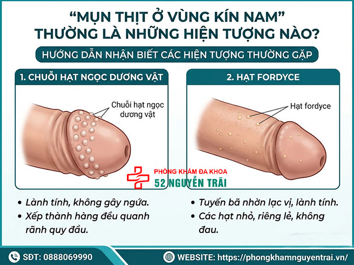 Mụn Thịt Ở Vùng Kín Nam Là Gì? Có Nguy Hiểm Không? 1 Mụn thịt ở vùng kín nam