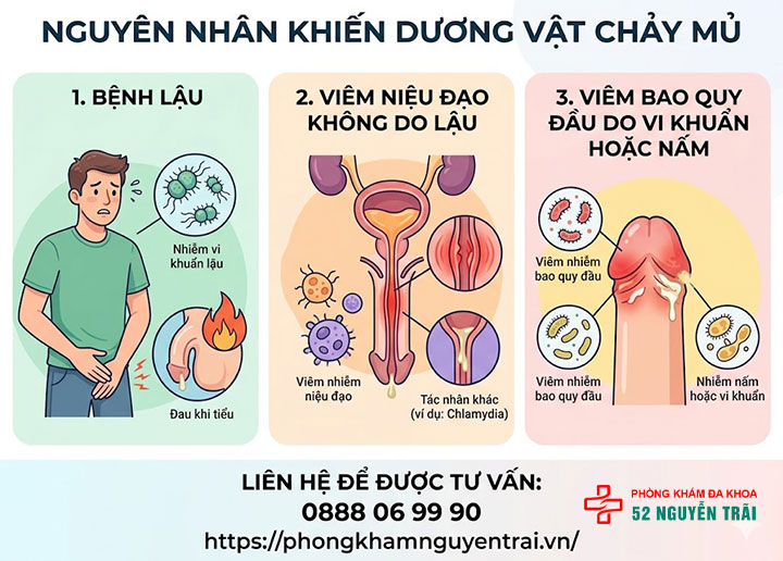 Dương vật chảy mủ: Nguyên nhân, biến chứng và cách điều trị 2 Nguyên nhân khiến dương vật chảy mủ
