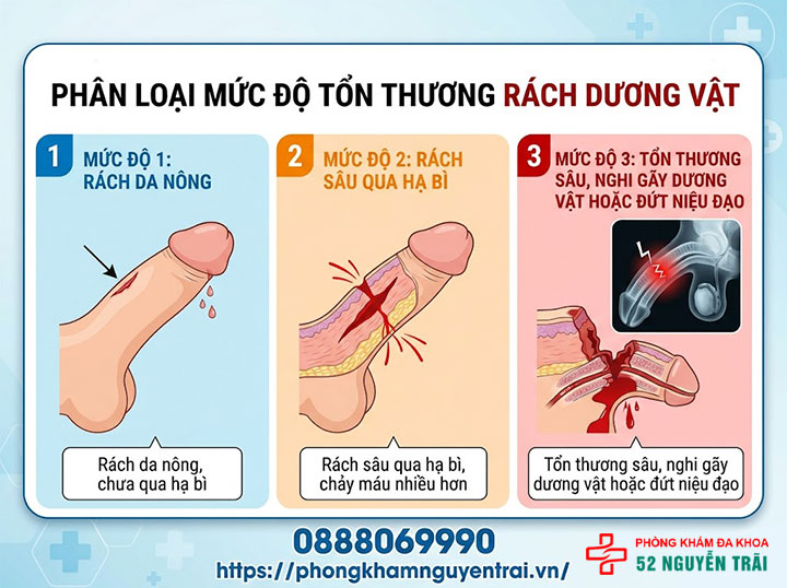 Rách Dương Vật: Nguyên Nhân & Cách Xử Trí Đúng 2 Phân loại mức độ tổn thương rách dương vật