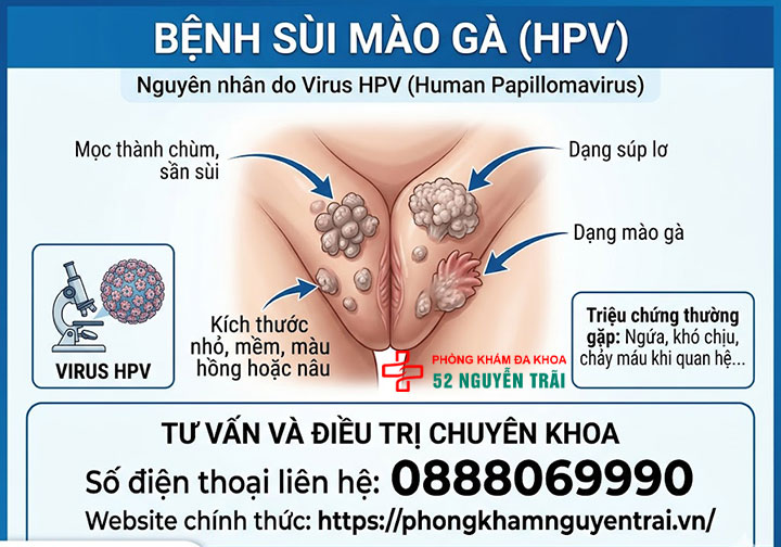 Mụn Thịt Ở Vùng Kín Nam Là Gì? Có Nguy Hiểm Không? 4 Sùi mào gà (Bệnh lý do virus HPV)