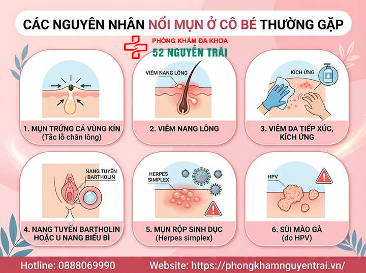 Nổi Mụn Ở Cô Bé: Nguyên Nhân Và Cách Xử Lý 3 Các nguyên nhân nổi mụn ở cô bé thường gặp