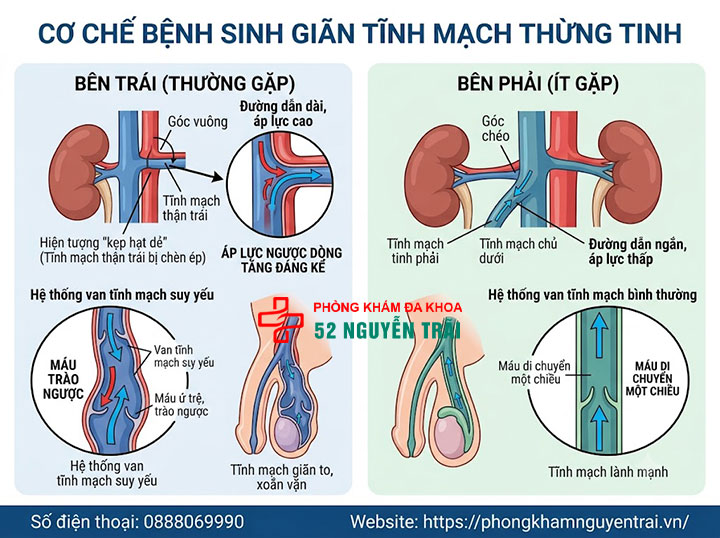 Giãn Tĩnh Mạch Thừng Tinh Là Gì? Tổng Quan Toàn Diện 2 Cơ chế bệnh sinh Giãn Tĩnh Mạch Thừng Tinh