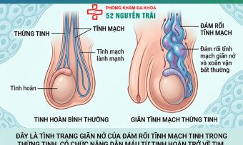 Giãn Tĩnh Mạch Thừng Tinh Là Gì? Tổng Quan Toàn Diện