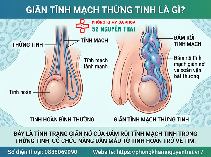Giãn Tĩnh Mạch Thừng Tinh Là Gì? Tổng Quan Toàn Diện 1 Giãn Tĩnh Mạch Thừng Tinh Là Gì?