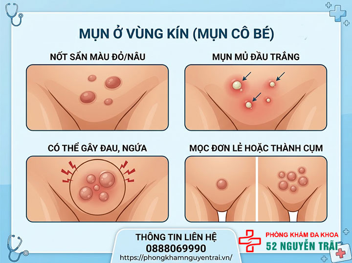 Nổi Mụn Ở Cô Bé: Nguyên Nhân Và Cách Xử Lý 1 Mụn ở cô bé trông như thế nào?