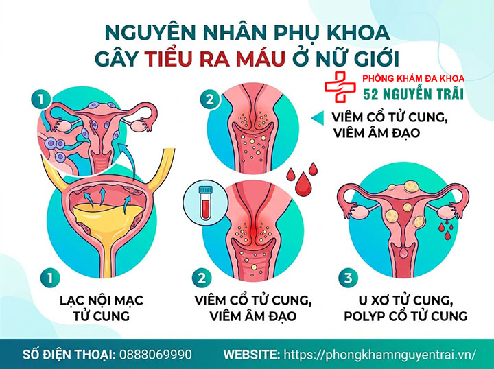 Tiểu Ra Máu Ở Nữ Là Bệnh Gì? Nguyên Nhân, Cách Xử Trí 4 Nguyên nhân phụ khoa gây tiểu ra máu ở nữ giới