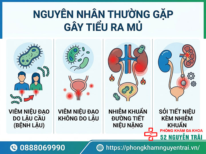 Tiểu Ra Mủ Là Bệnh Gì? Nguyên Nhân Và Cách Điều Trị 2 Nguyên nhân thường gặp gây tiểu ra mủ