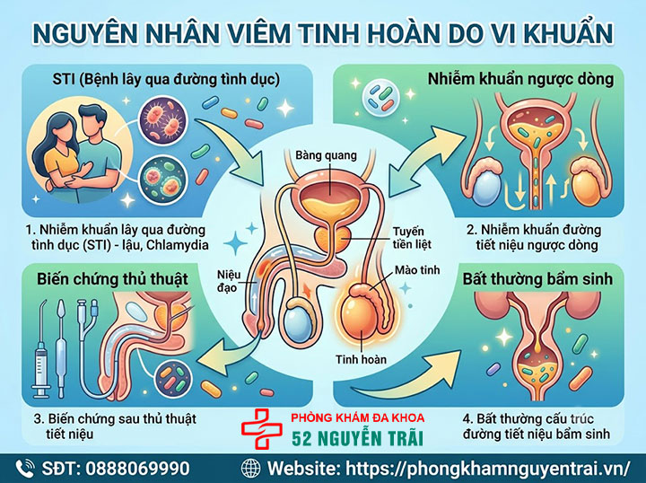 Viêm tinh hoàn là gì? Nguyên nhân, triệu chứng, cách điều trị 2 Nguyên nhân viêm tinh hoàn do vi khuẩn