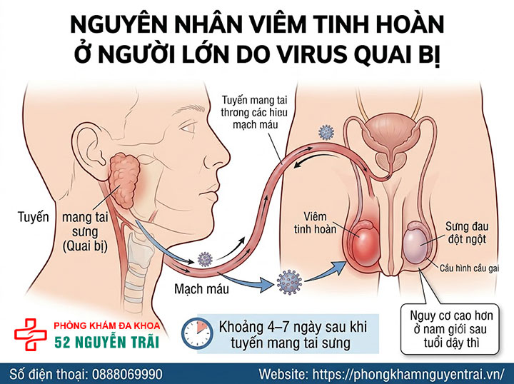 Viêm tinh hoàn là gì? Nguyên nhân, triệu chứng, cách điều trị 3 Nguyên nhân viêm tinh hoàn ở người lớn do virus quai bị