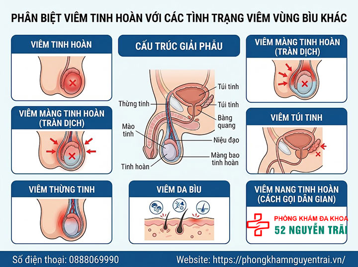 Viêm tinh hoàn là gì? Nguyên nhân, triệu chứng, cách điều trị 7 Phân Biệt Viêm Tinh Hoàn Với Các Tình Trạng Viêm Vùng Bìu Khác