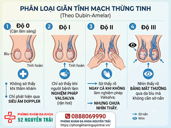 Giãn Tĩnh Mạch Thừng Tinh Là Gì? Tổng Quan Toàn Diện 4 Phân Loại Giãn Tĩnh Mạch Thừng Tinh theo mức độ (phân độ Dubin-Amelar)