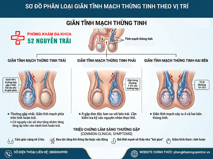 Giãn Tĩnh Mạch Thừng Tinh Là Gì? Tổng Quan Toàn Diện 3 Phân Loại Giãn Tĩnh Mạch Thừng Tinh theo vị trí (trái – phải – hai bên)