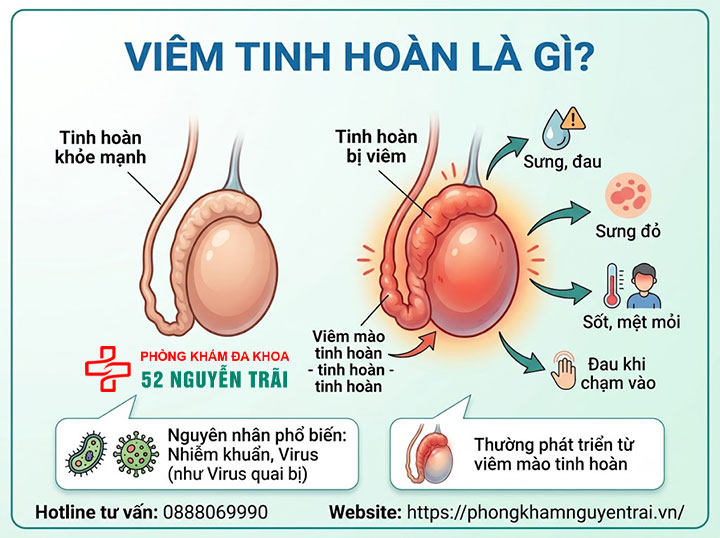 Viêm tinh hoàn là gì? Nguyên nhân, triệu chứng, cách điều trị 1 Viêm Tinh Hoàn Là Gì?